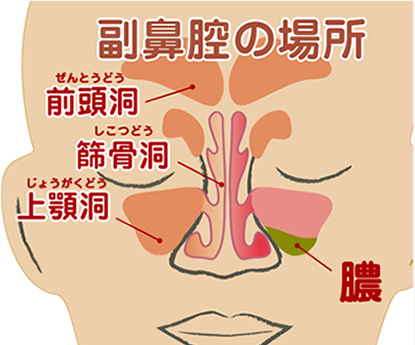 副鼻腔炎