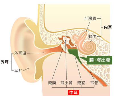 滲出性中耳炎