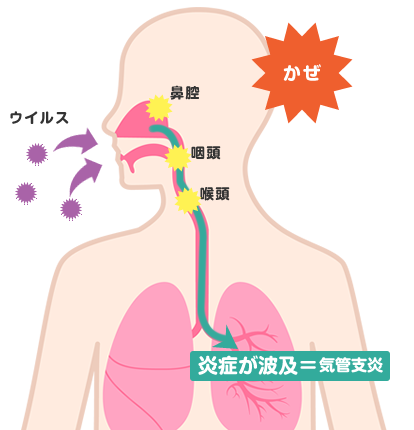 急性気管支炎